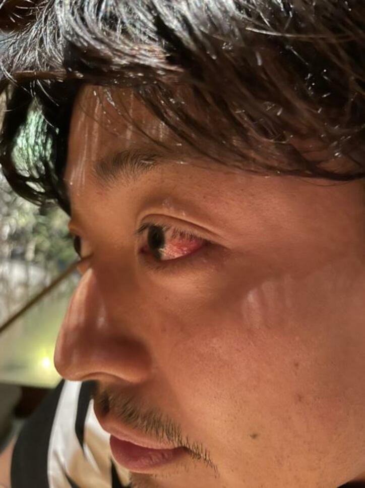  中村昌也、目に痛みがあり病院へ行った結果「テンション下がる」 