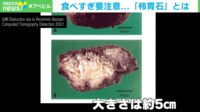 食べすぎ要注意...「柿胃石」とは