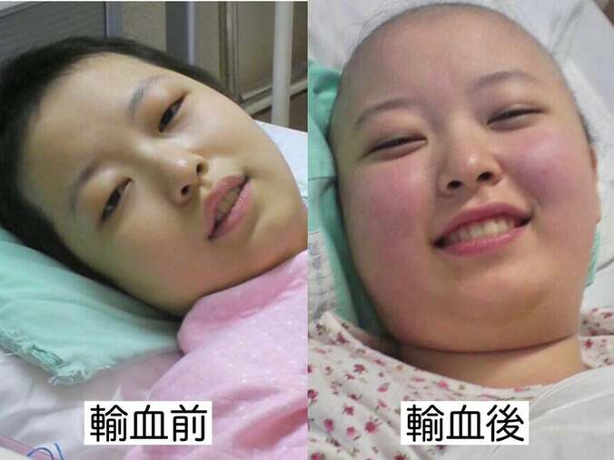 女優・友寄蓮、治療中に輸血を受けた回数は100回以上「輸血前後の顔色はこれくらい違います」  1枚目