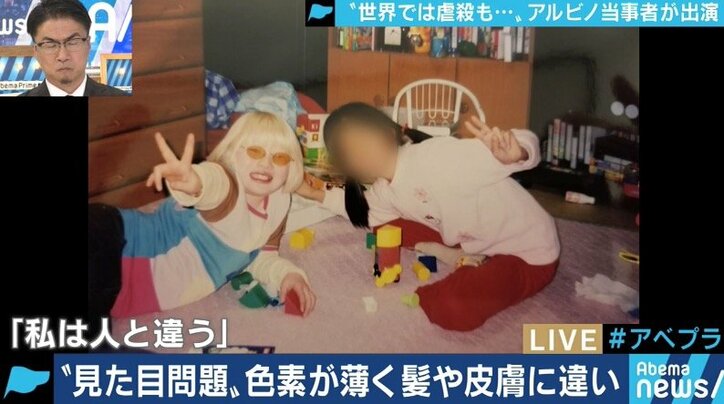 生まれつき色素が薄いアルビノ当事者の苦しみ カラーコードに合わないから バイト 就職を断られるケースも 国内 Abema Times