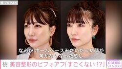 あいのり桃、美容整形のビフォーアフターを公開「20年前との差におったまげ」「10才以上若返って見えるね」ファンも驚き