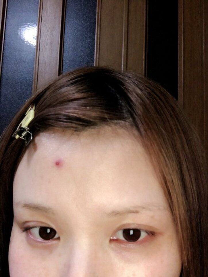 はんにゃ・川島の妻、額のニキビで出産日を予想「これが何かしらの暗示だとするならば」