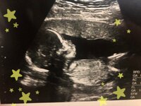 柔美＆都美『帝王切開レポ①』