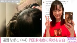 摂食障害公表の遠野なぎこ、円形脱毛症の現状を赤裸々告白 「おハゲちゃんが広域に」