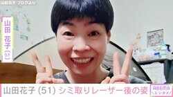 山田花子（51）、シミ取りレーザー後の姿に反響「ますます美しくなりますね」