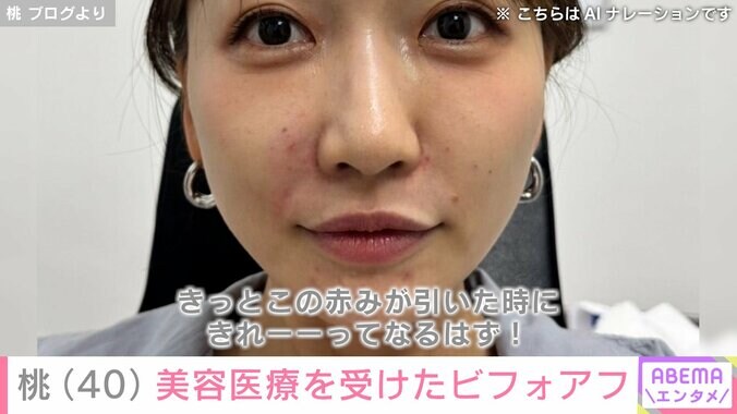 【写真・画像】“3度の二重整形”桃(40) ほうれい線対策の最新美容医療を受けたビフォーアフターを公開　2枚目