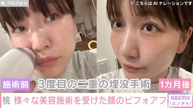 “3度の二重施術”桃、目元の美容施術のビフォーアフターを公開 3枚目