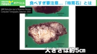 食べすぎ要注意...「柿胃石」とは