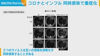 コロナとインフル同時感染で重症化
