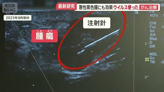 腫瘍にウイルスを投与