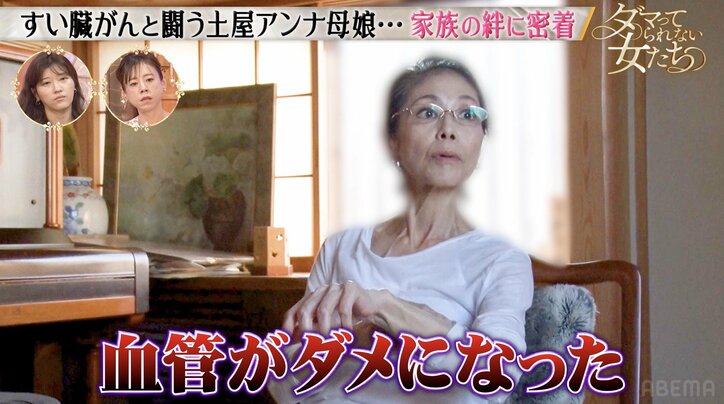 【写真・画像】内出血でパンパンに…ステージ4のすい臓がん 土屋アンナの母、抗がん剤治療を受けるも血管が針を拒絶　2枚目