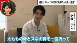 500万円で“身長10センチ”を買った男性「太もも、スネの骨を人工的に一回折って…」 驚きの手法も整形外科医「5カ月あれば運動能力を回復できる」
