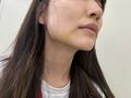  あいのり・桃、美容施術のダウンタイム中の自撮りショットを公開「顎横あたりが黄色くなってます」 
