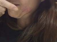 大島奈保美『レーザー治療後の経過報告』