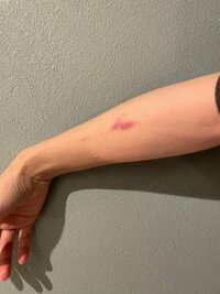 桃『アザがひどい…。犯人は…』