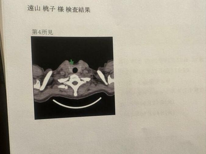  あいのり・桃、人間ドックの結果が届き唖然「たしかに触ってみたらシコリっぽい」  1枚目