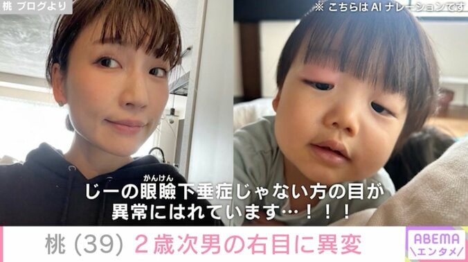 【写真・画像】あいのり桃、眼瞼下垂症公表の2歳次男の右目に異変「異常にはれています」　1枚目