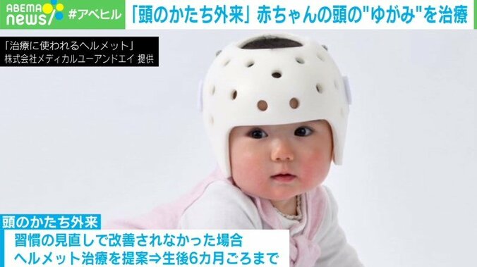 頭の変形を専門に扱う“頭のかたち外来”  費用は数十万円　成長で改善？治療したほうがいい？判断の難しさも 3枚目