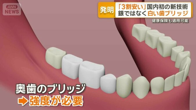 ブリッジ治療