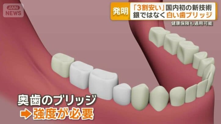 ブリッジ治療