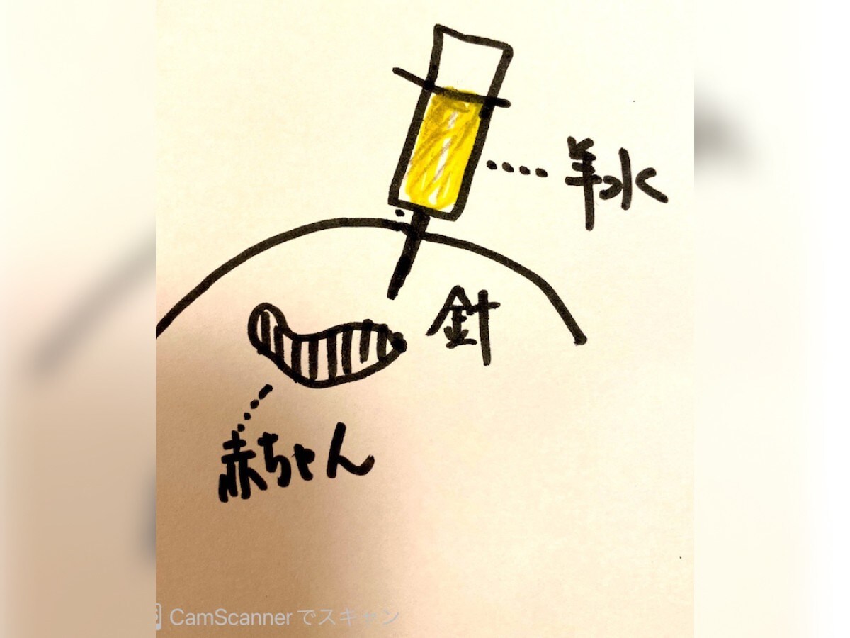 著者 講演家の立石美津子さん 流産の可能性を告げられた羊水検査 流産の危険が３ あります 話題 Abema Times