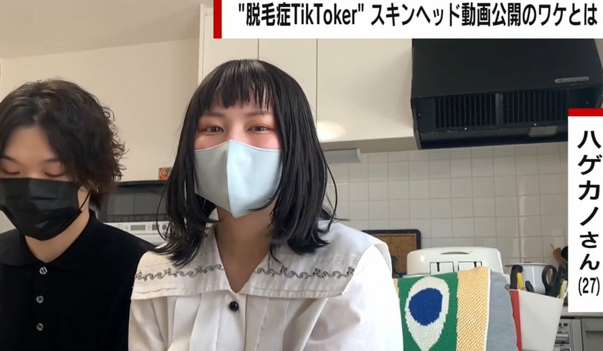 無毛症 高校2年で髪が抜け落ちた女性 包み隠さず“脱毛症生活”を発信 彼女を前向きにした恋人の言葉 | 国内 | ABEMA TIMES | アベマタイムズ