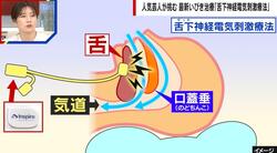 舌に電気刺激を与える治療？“睡眠時無呼吸症候群”に有効な「舌下神経電気刺激療法」医師が解説