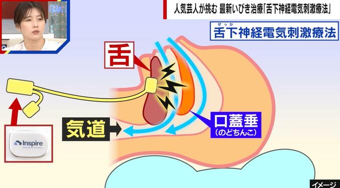 【写真・画像】舌に電気刺激を与える治療？“睡眠時無呼吸症候群”に有効な「舌下神経電気刺激療法」医師が解説