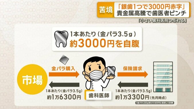 銀歯1本あたり3000円自腹
