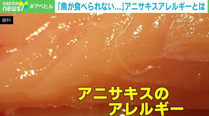 死の一歩手前まで…「一生、魚を食べられない可能性がある」男性に話を聞く 日本人が特に注意すべき“アニサキスアレルギー”の危険性とは？