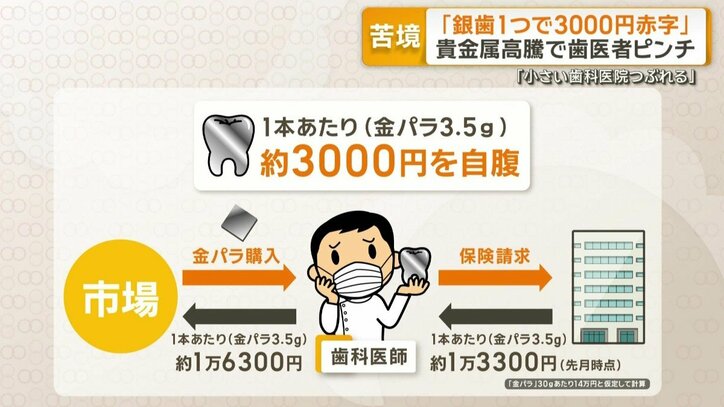 銀歯1本あたり3000円自腹