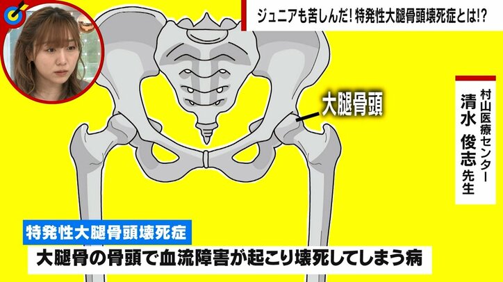 「両方の股関節と膝が壊死した」女優を目指した若い女性の告白 発症率5万人に1人の難病は「反対にへし折られている痛み」