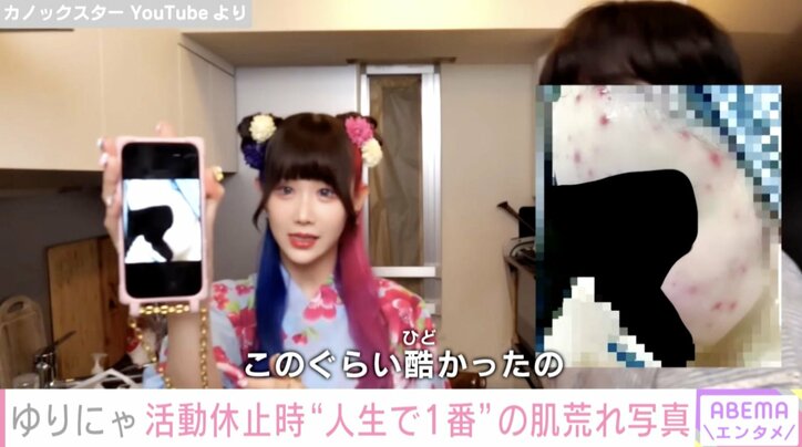 ウエスト50.7cm“異次元のスタイル”ゆりにゃ、過去1の肌荒れ写真を公開「見えないところでたくさん頑張っているのがすごく伝わる」ファンから称賛の声