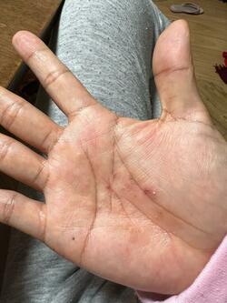  あいのり・クロ、アトピーを疑う酷い自身の症状「かきすぎて、血が出たりして」 