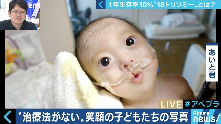 “1年以上の生存率は10％”…18トリソミー児の家族たちが写真展に託した苦悩と葛藤