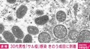 成田空港に到着した男性のサル痘陽性が判明 千葉県「空港で相談してくれたので早期に診断ができた」