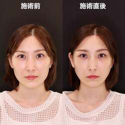  はあちゅう氏、施術を受け驚いたビフォーアフター「全力笑顔するとちょっとひきつる」 