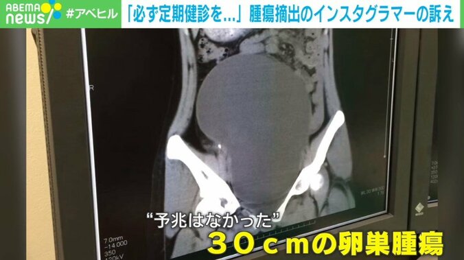 「傷口が勲章に」 2度の“卵巣腫瘍”摘出…病気と向き合う日々を発信するインフルエンサーの願い 2枚目