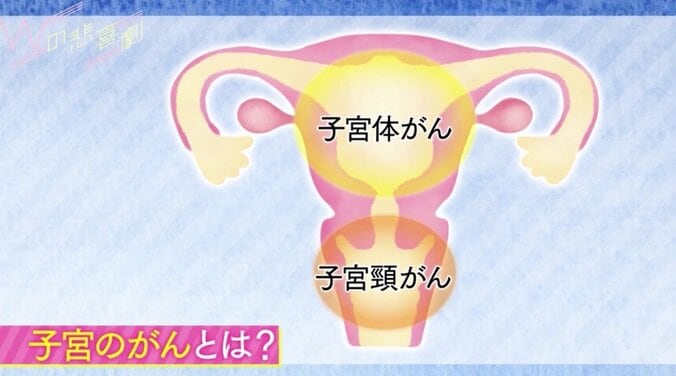 「子宮頸がん」の偏見と予防ワクチンの真実  「性交渉が豊富」は大事じゃない 3枚目