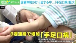手足口病が拡大… 医療体制ひっ迫の中、受診は可能か 専門家「判断は医師側に任せて」
