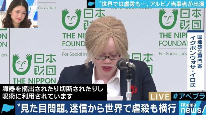生まれつき色素が薄いアルビノ当事者の苦しみ「カラーコードに合わないから‥」バイト・就職を断られるケースも 2枚目