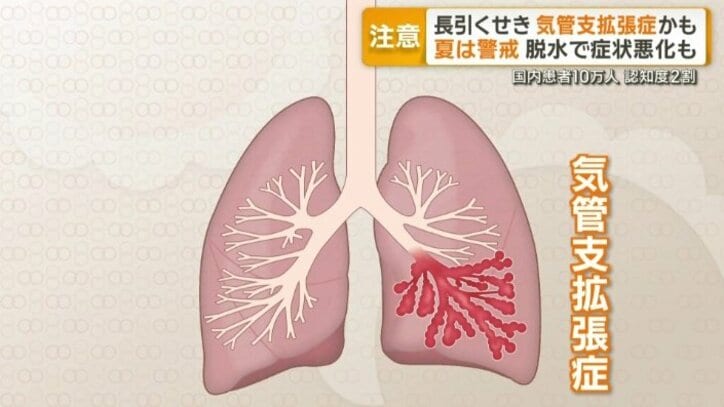 気管支拡張症