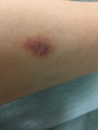 金田朋子『キスマーク⁈つけられました（笑）(^◇^;)』