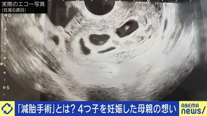 4つ子を妊娠で“減胎手術”