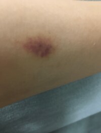 金田朋子、腕につけられたキスマークを公開「こんなことに？！」