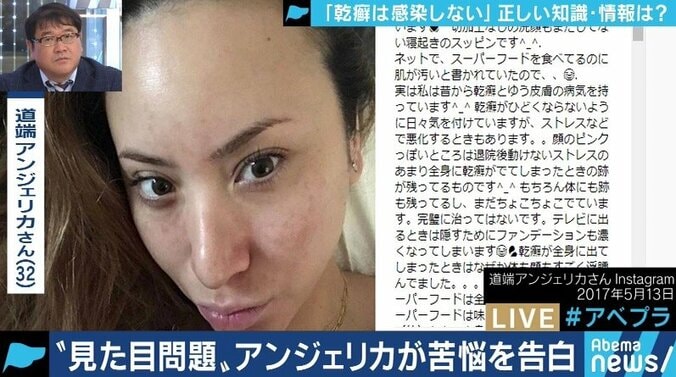 患者が告白「結婚は難しいと言われショックを受けた」　道端アンジェリカも誤解と偏見に苦しむ「乾癬」とは 2枚目