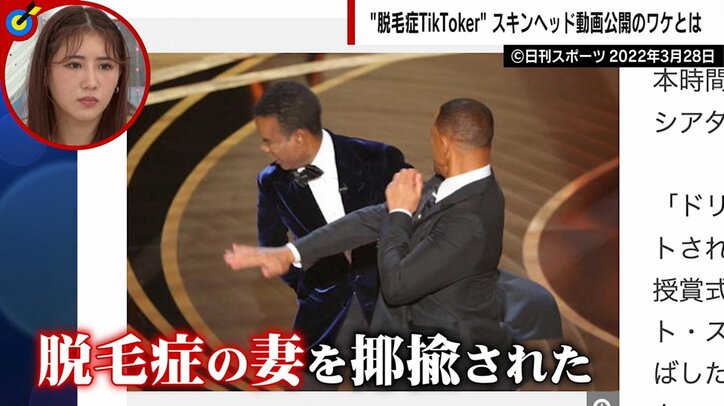 高校2年で髪が抜け落ちた女性 包み隠さず“脱毛症生活”を発信 彼女を前向きにした恋人の言葉