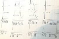エド・はるみ『手の痺れの原因』