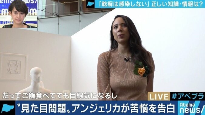 患者が告白「結婚は難しいと言われショックを受けた」　道端アンジェリカも誤解と偏見に苦しむ「乾癬」とは 1枚目