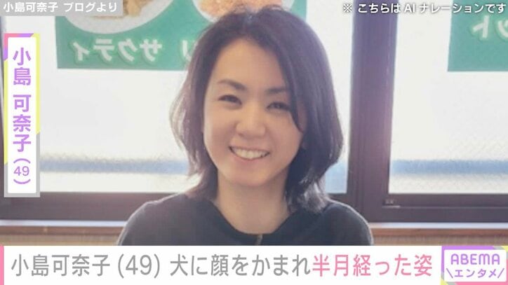 【写真・画像】犬に顔をかまれ約30針縫った小島可奈子、半月経った姿を公開「やけどより5倍深い傷なので残りますときっぱり言われまして」　1枚目